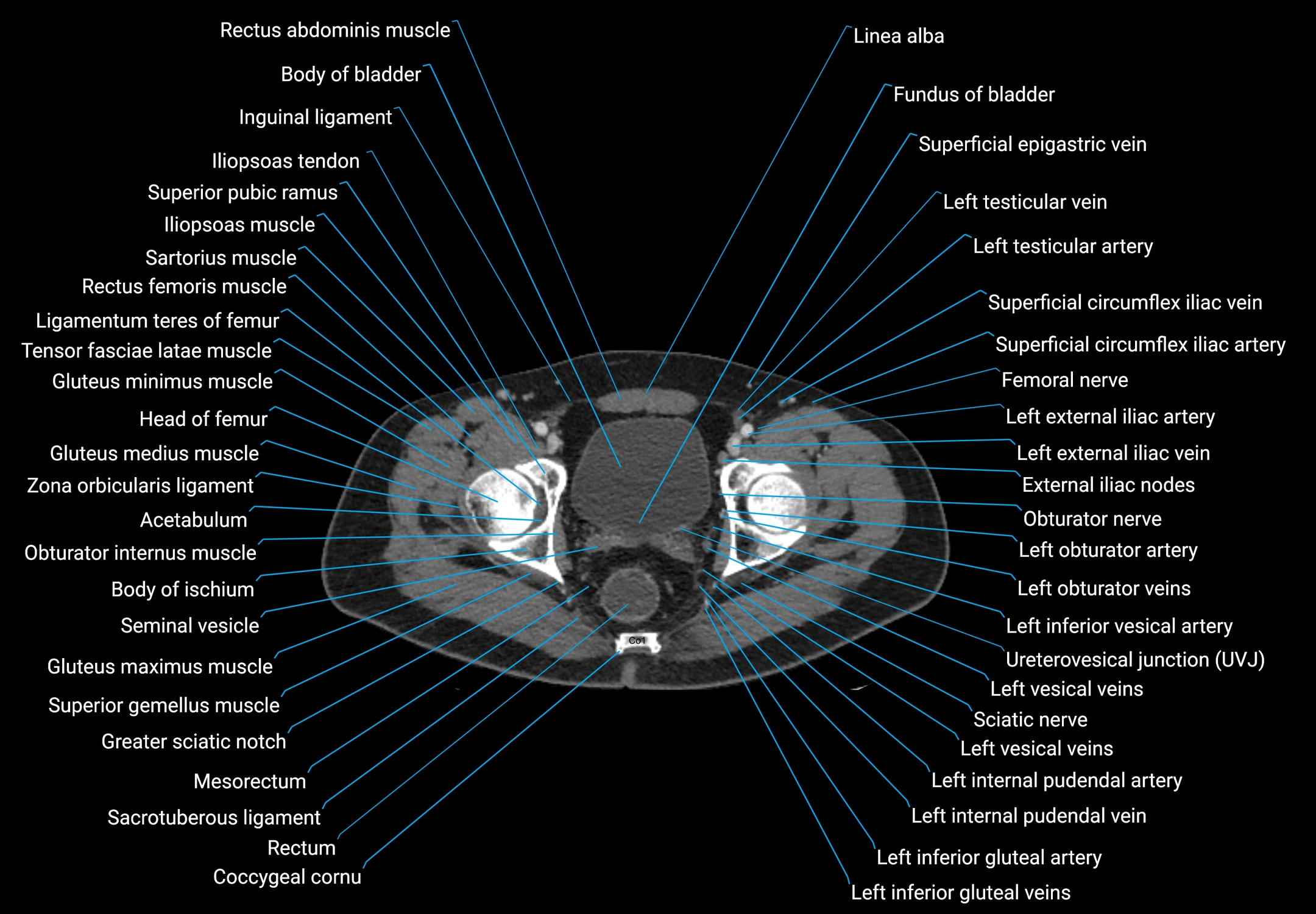 CT male pelvis axial cross sectional anatomy labelled radiology image -00183.webp